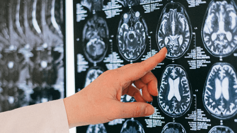 Identifican señales cerebrales tempranas para detener convulsiones con estimulación profunda